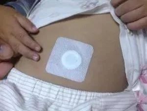 小儿积滞，秘密武器来帮你——敷贴器